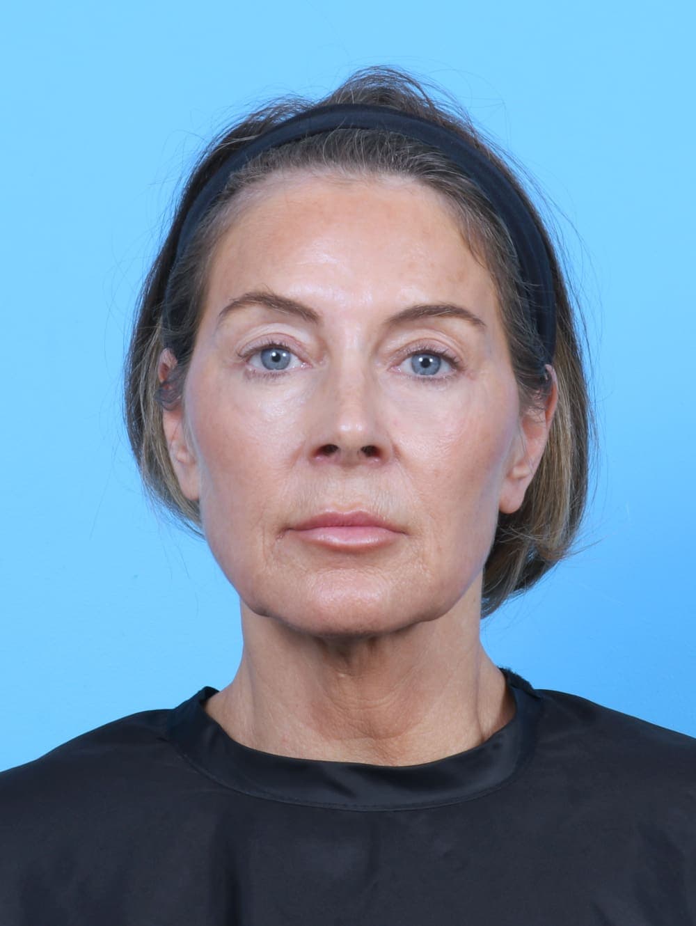 Eyelid Surgery case #5865 after, image 1