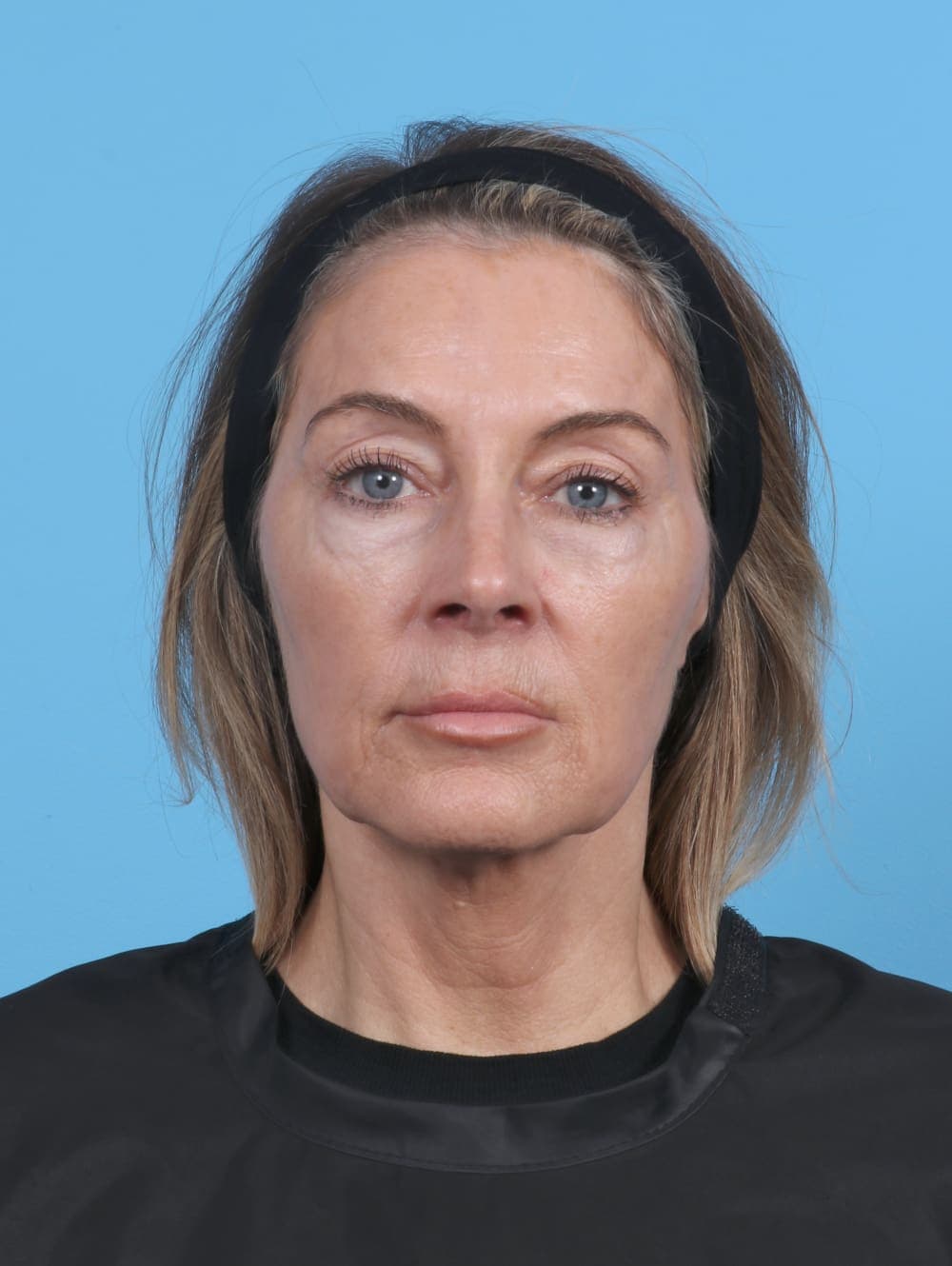 Eyelid Surgery case #5865 before, image 1