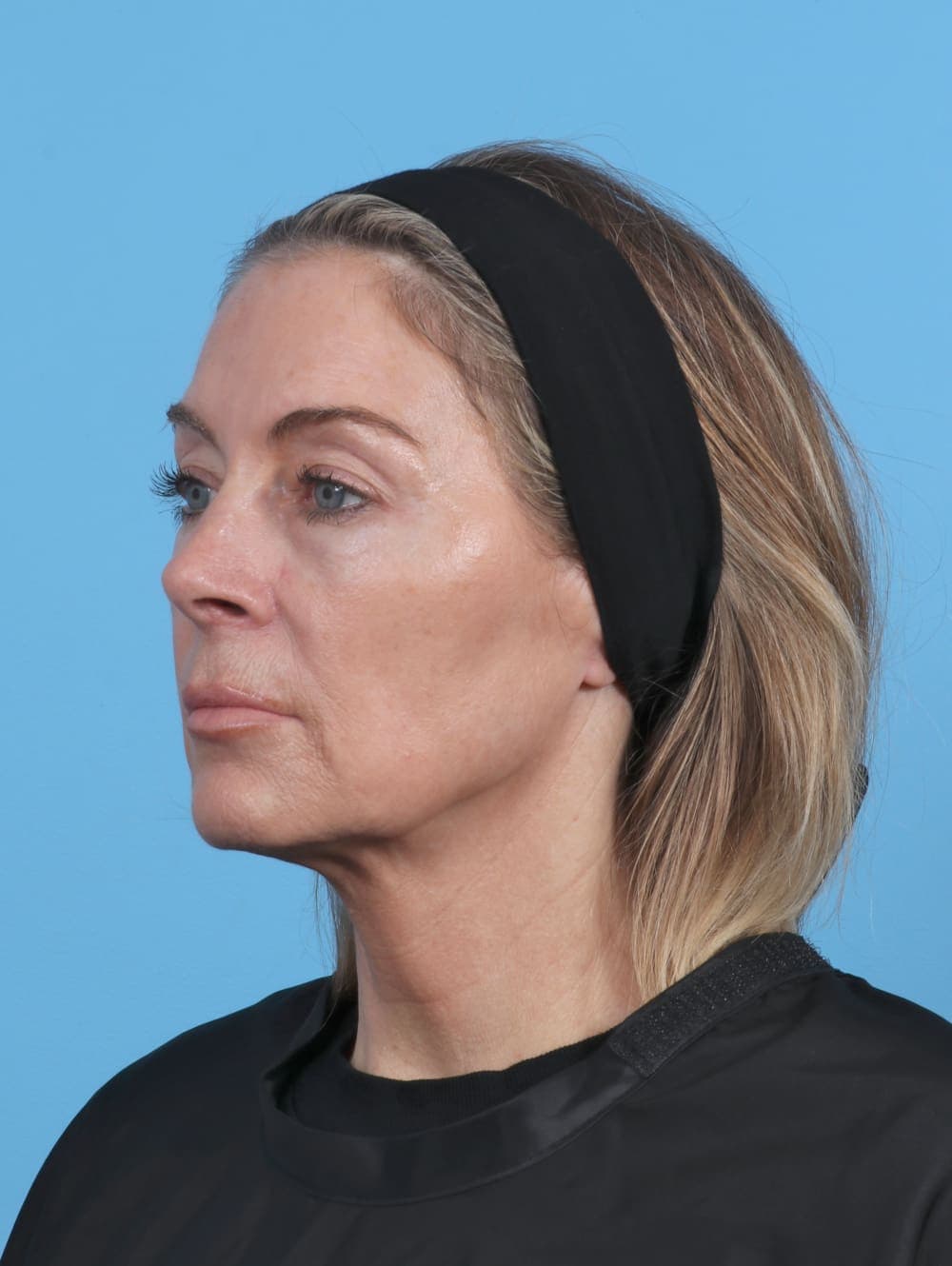 Eyelid Surgery case #5865 before, image 2