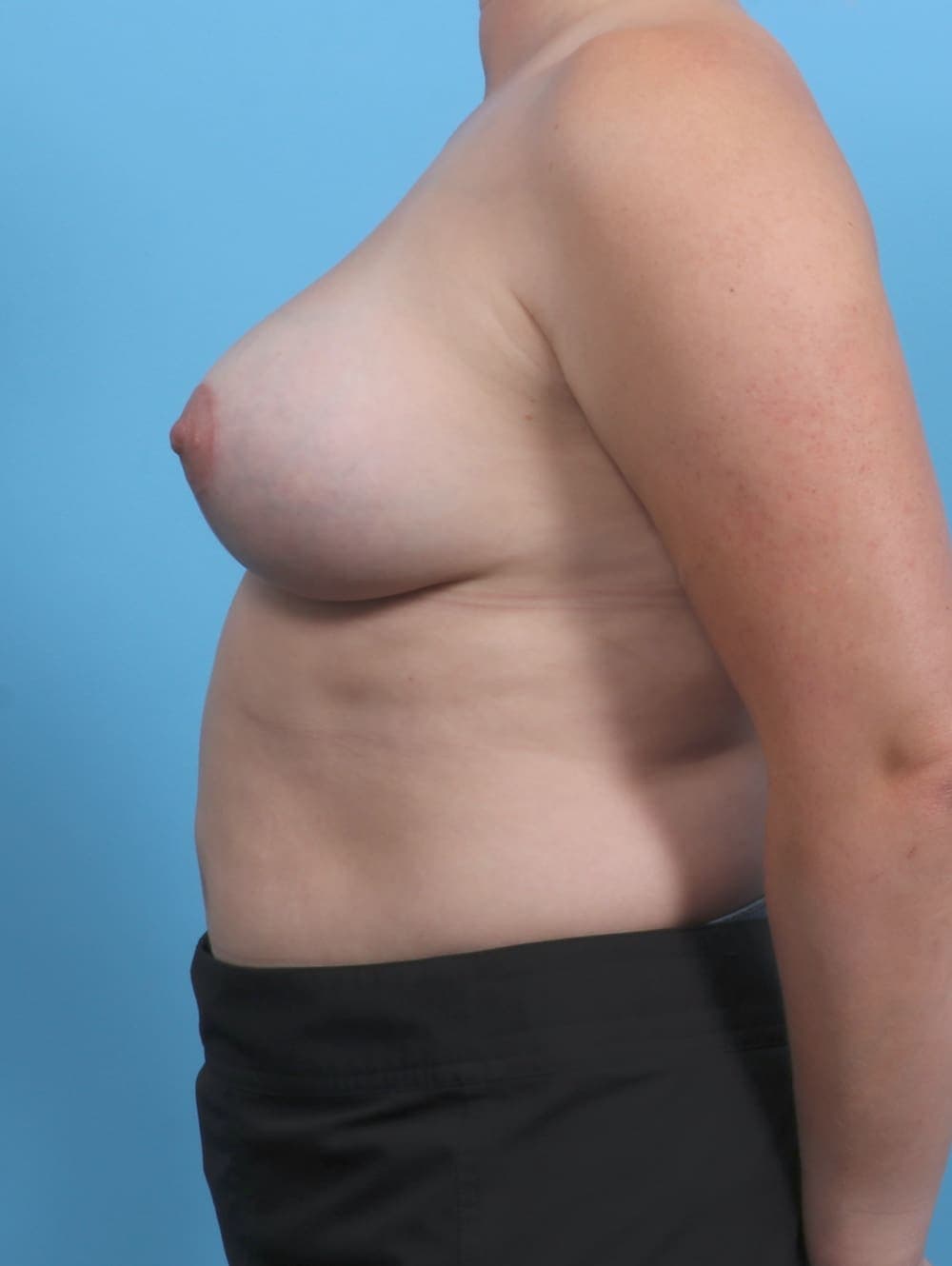 Breast Lift with Implants case #3983 after, image 3