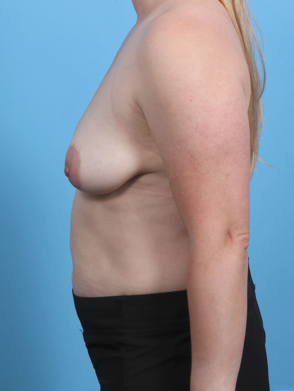 Breast Lift with Implants case #3983 before, image 3