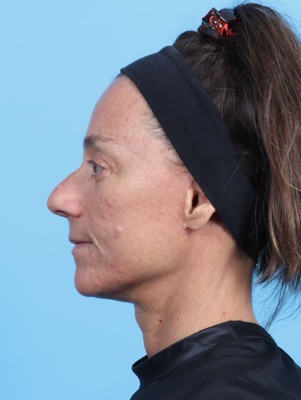 Facelift case #2536 after, image 3
