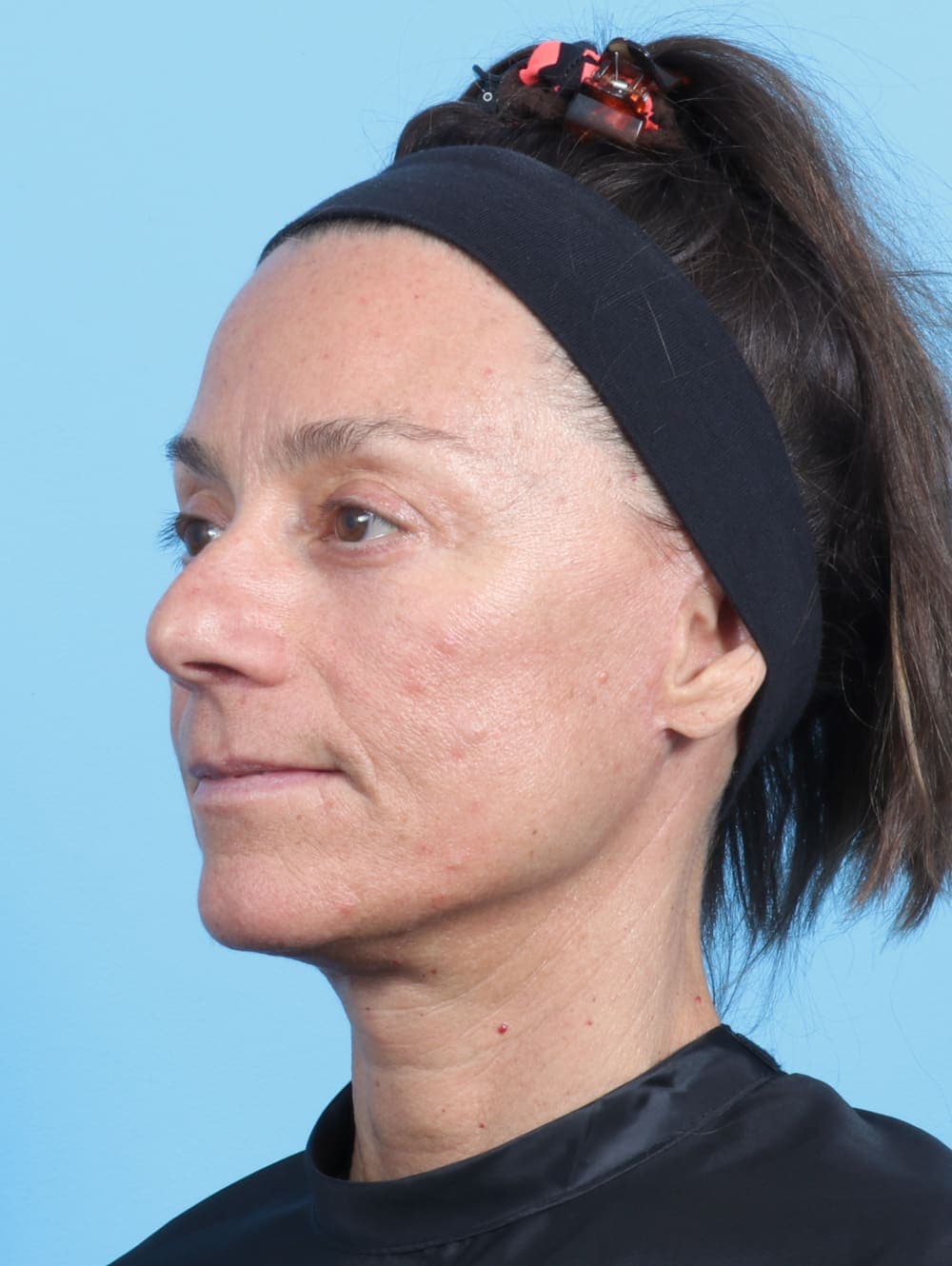 Facelift case #2536 after, image 2