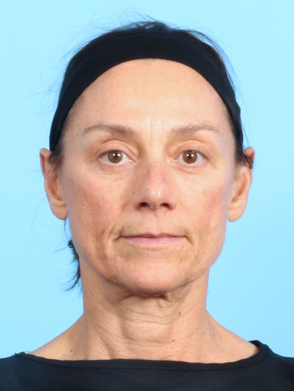 Facelift case #2536 before, image 1