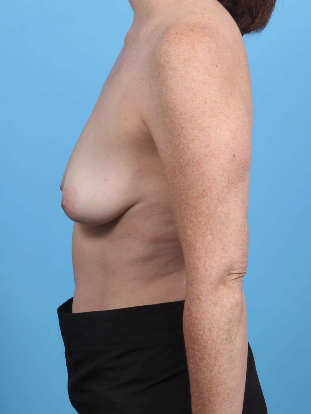 Breast Lift/Reduction case #4171 before, image 3
