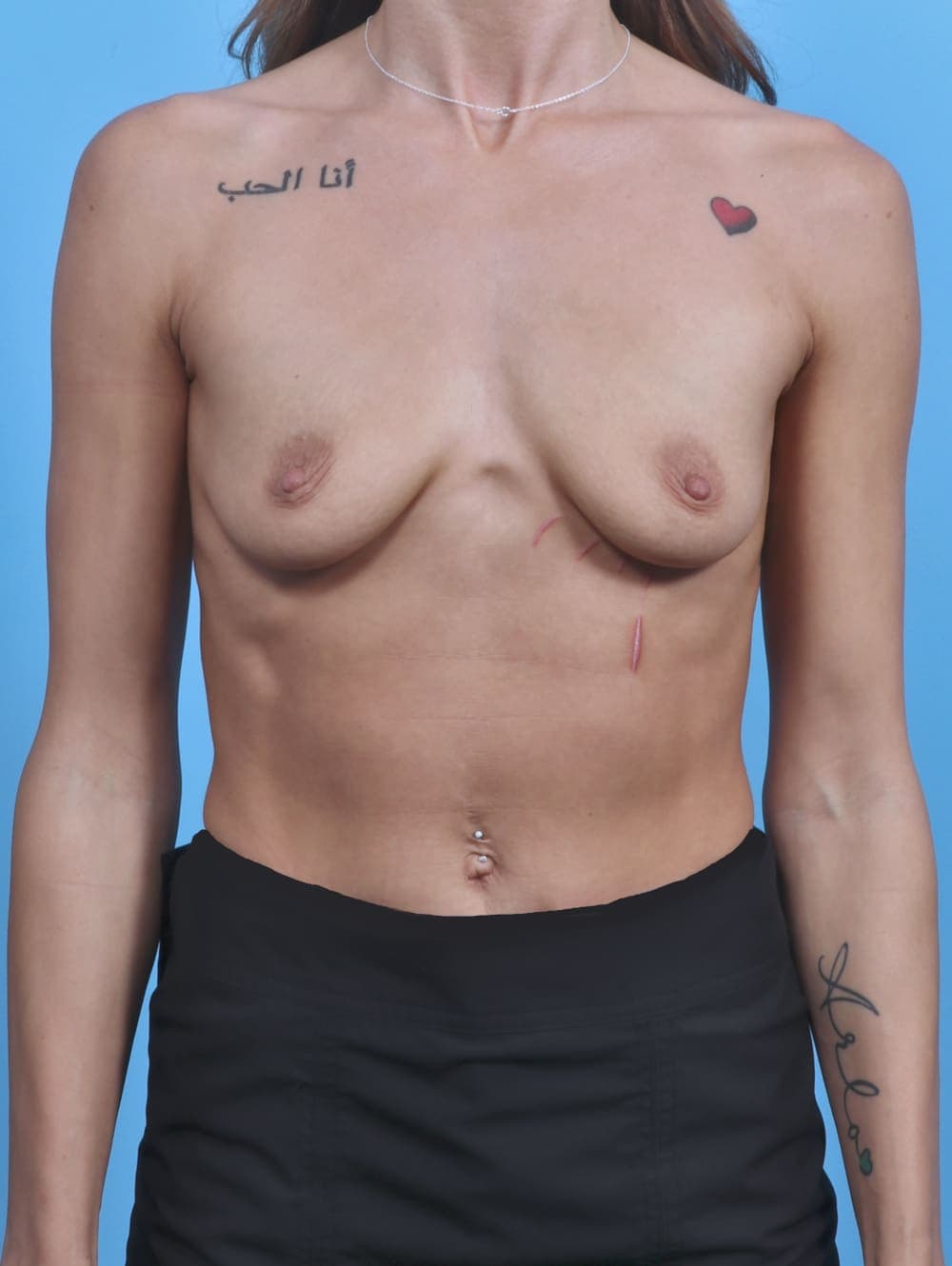 Breast Augmentation case #4455 before, image 1