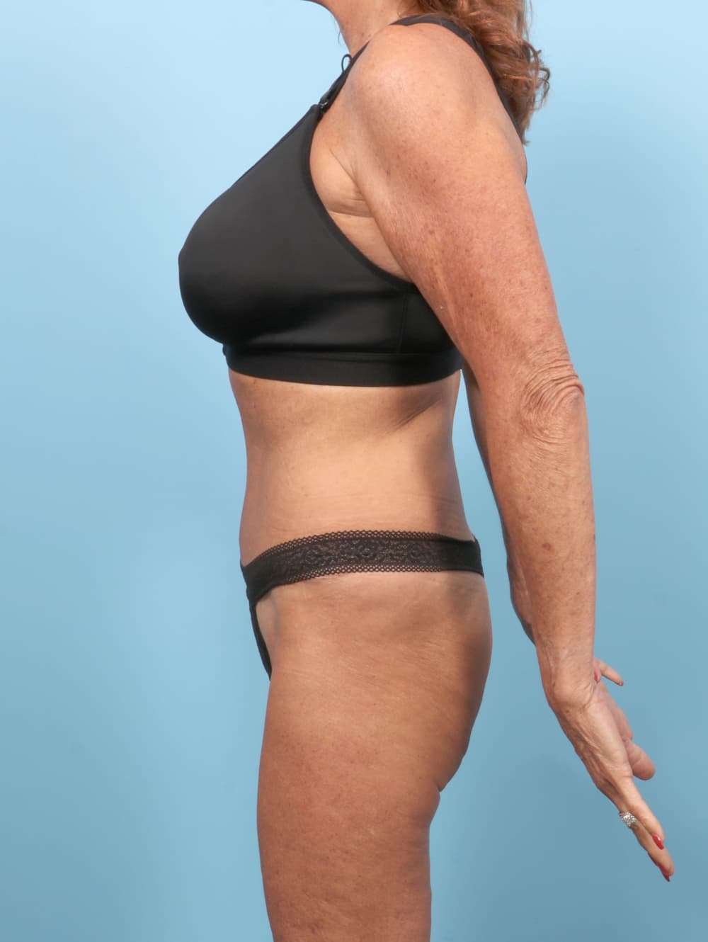 Tummy Tuck case #7551 after, image 3