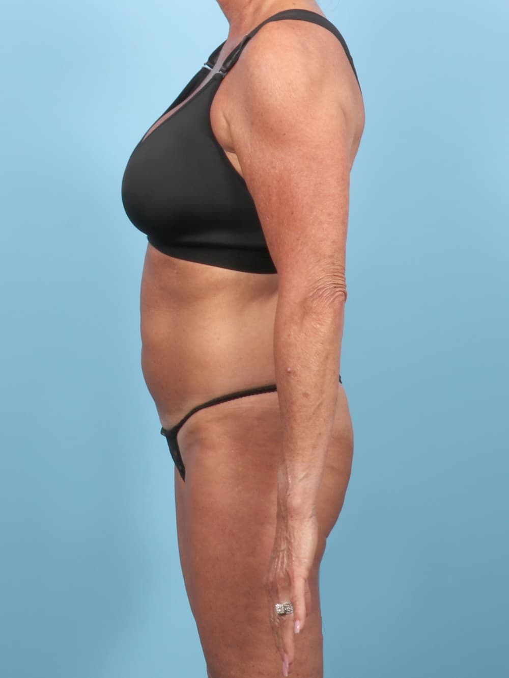 Tummy Tuck case #7551 before, image 3