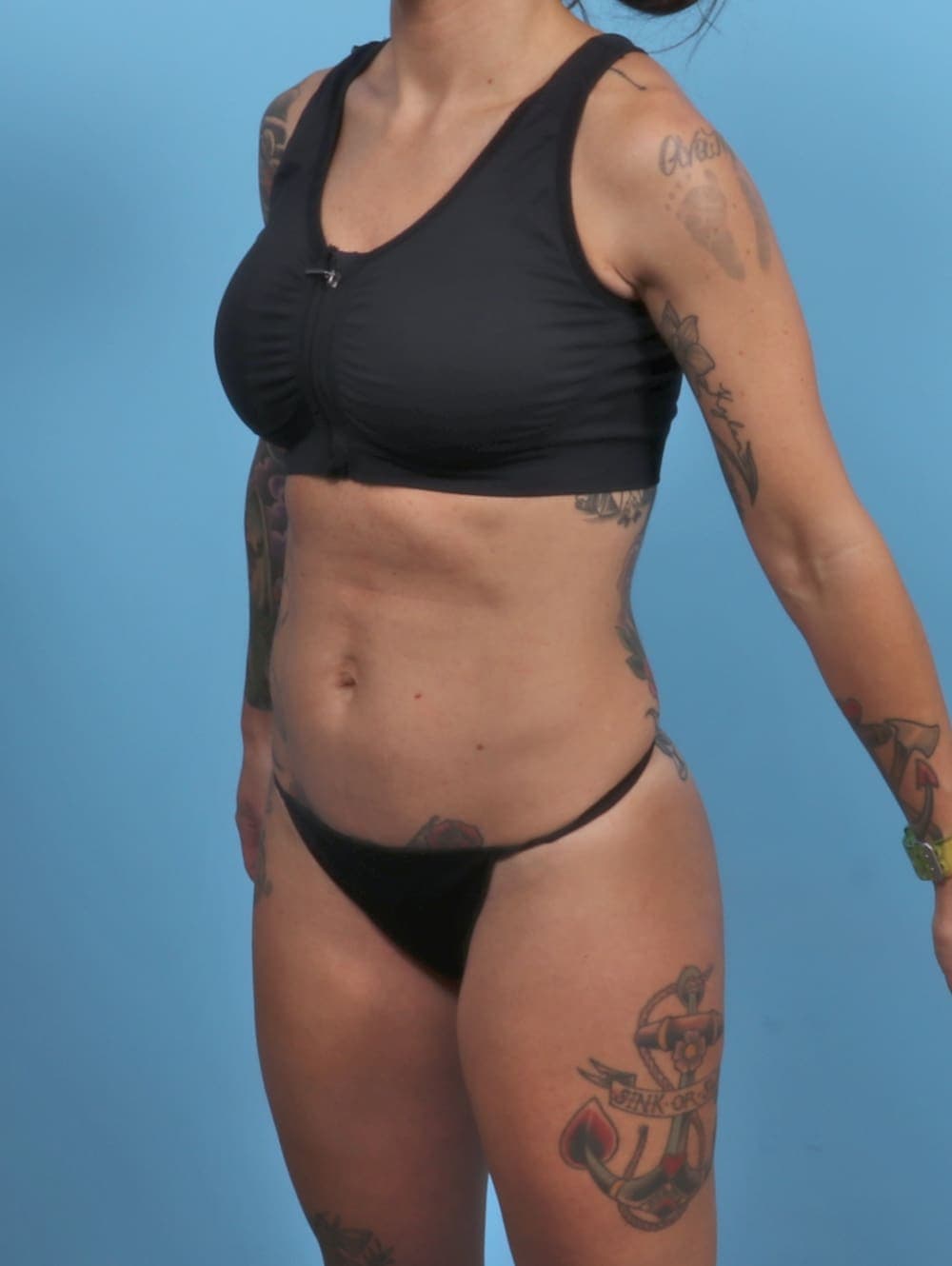 Tummy Tuck case #4884 before, image 2
