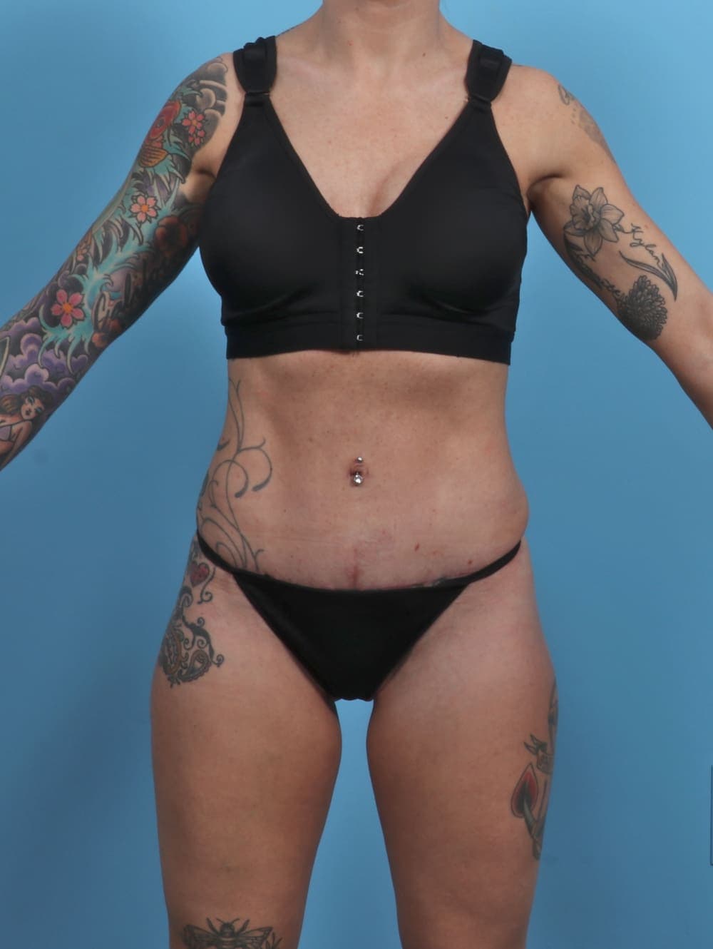 Tummy Tuck case #4884 after, image 1