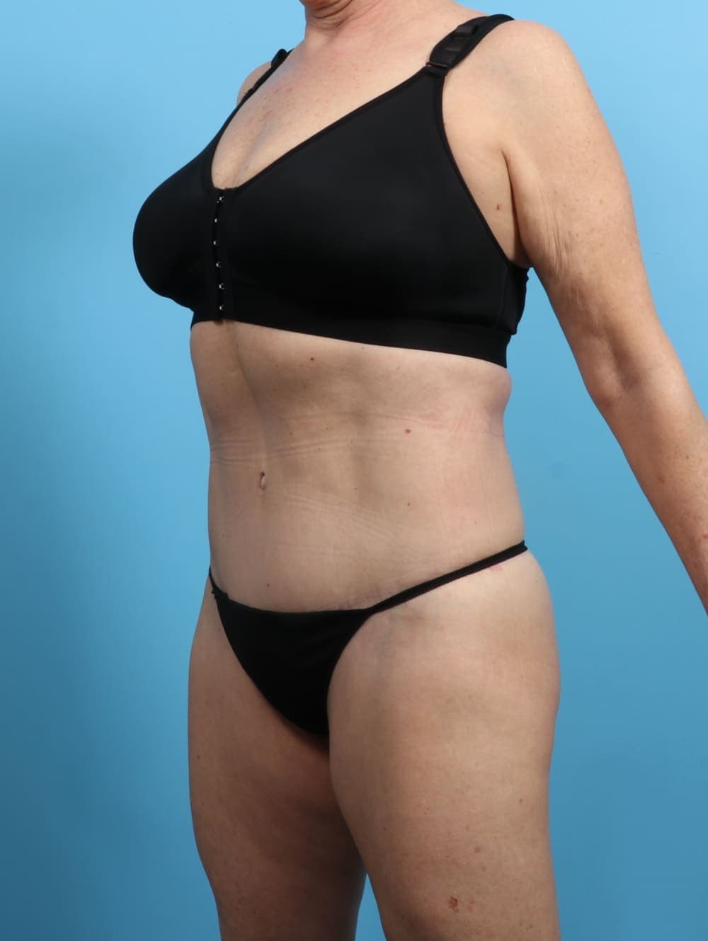 Body Lift case #3245 after, image 3