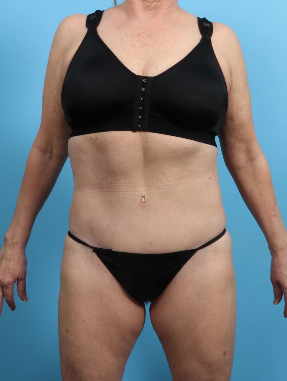 Body Lift case #3245 after, image 1