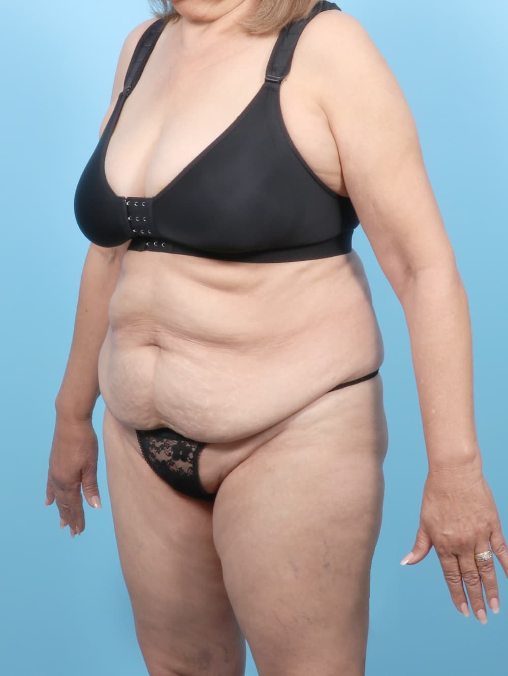 Tummy Tuck case #7501 before, image 2