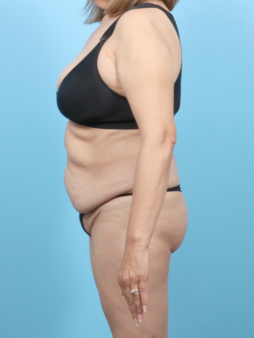 Tummy Tuck case #7501 before, image 3