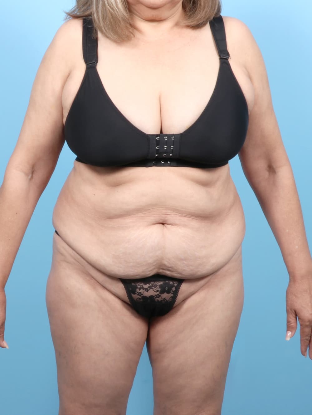Tummy Tuck case #7501 before, image 1