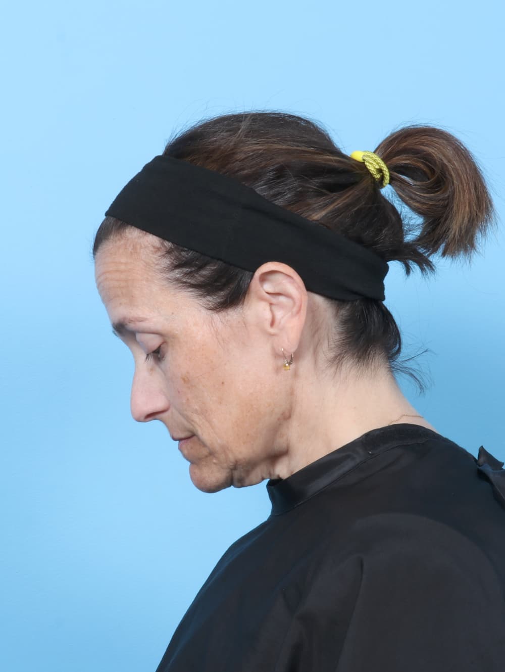 Facelift case #8748 before, image 3