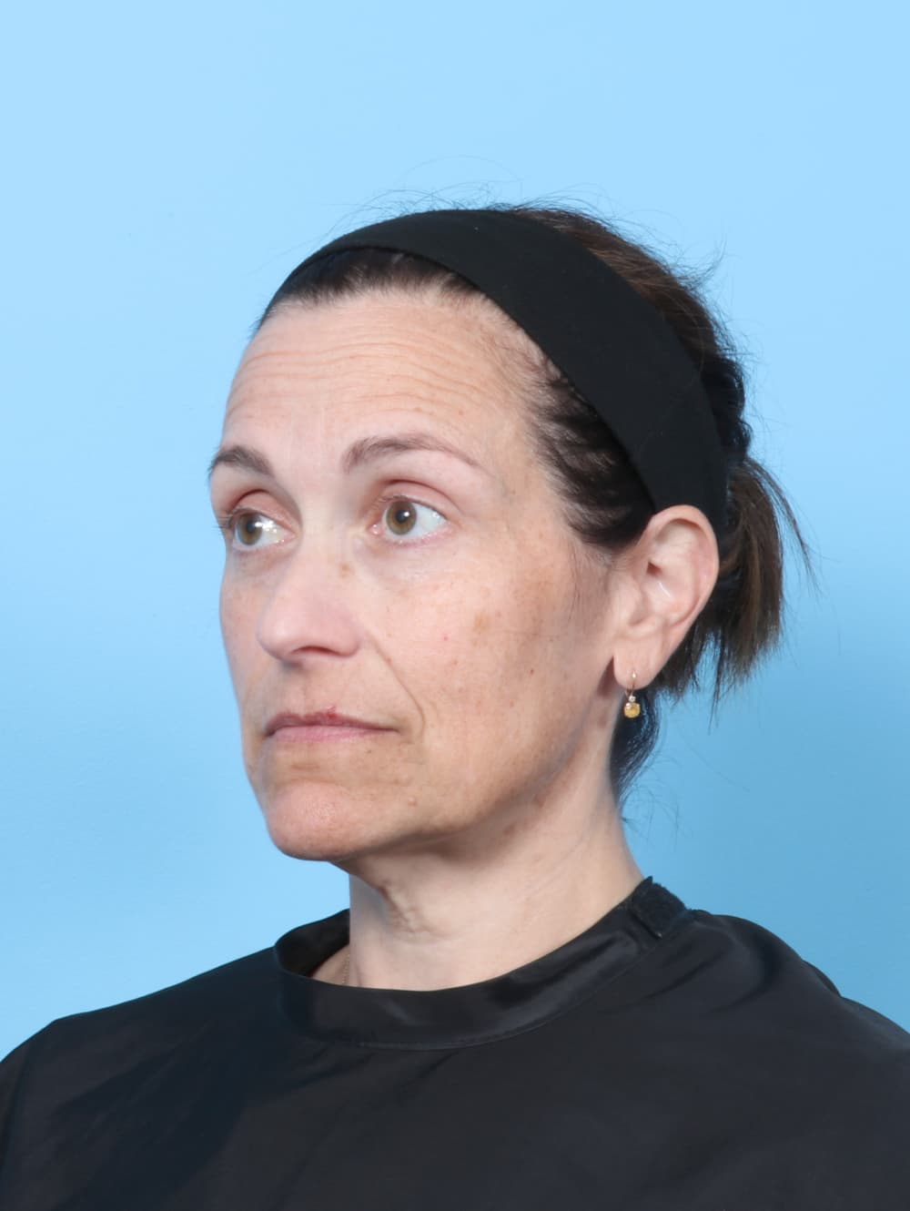 Facelift case #8748 before, image 2