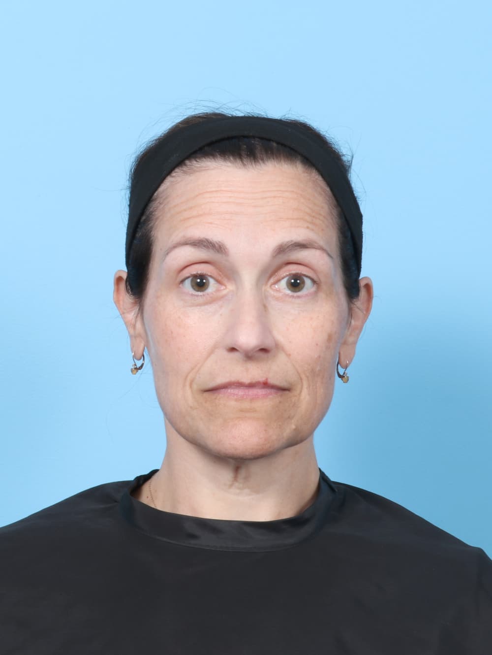 Facelift case #8748 before, image 1