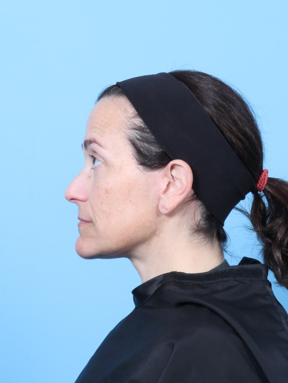 Facelift case #8748 after, image 4