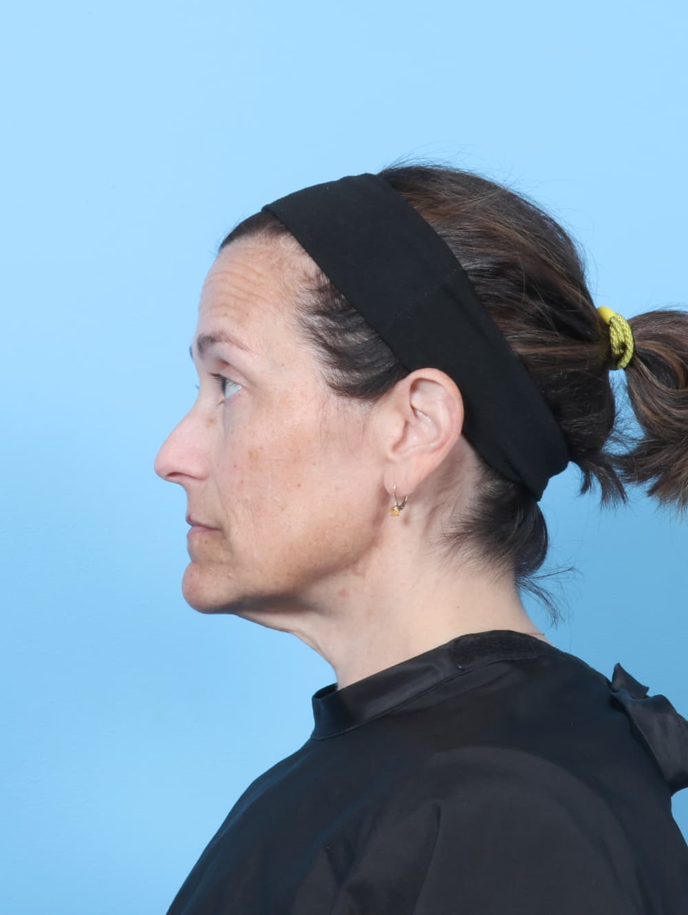 Facelift case #8748 before, image 4