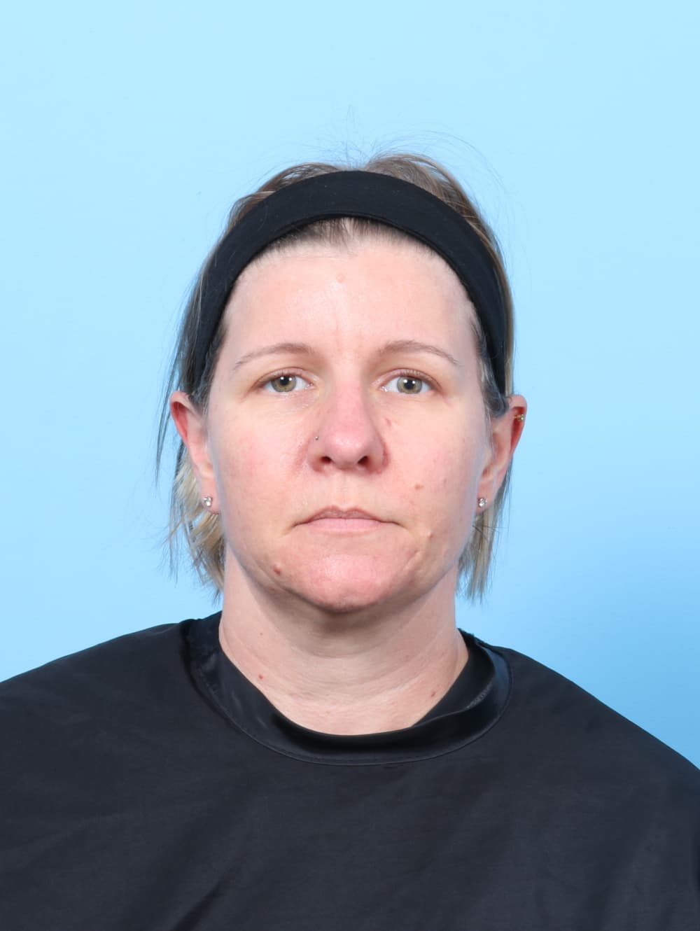 Eyelid Surgery case #8610 after
