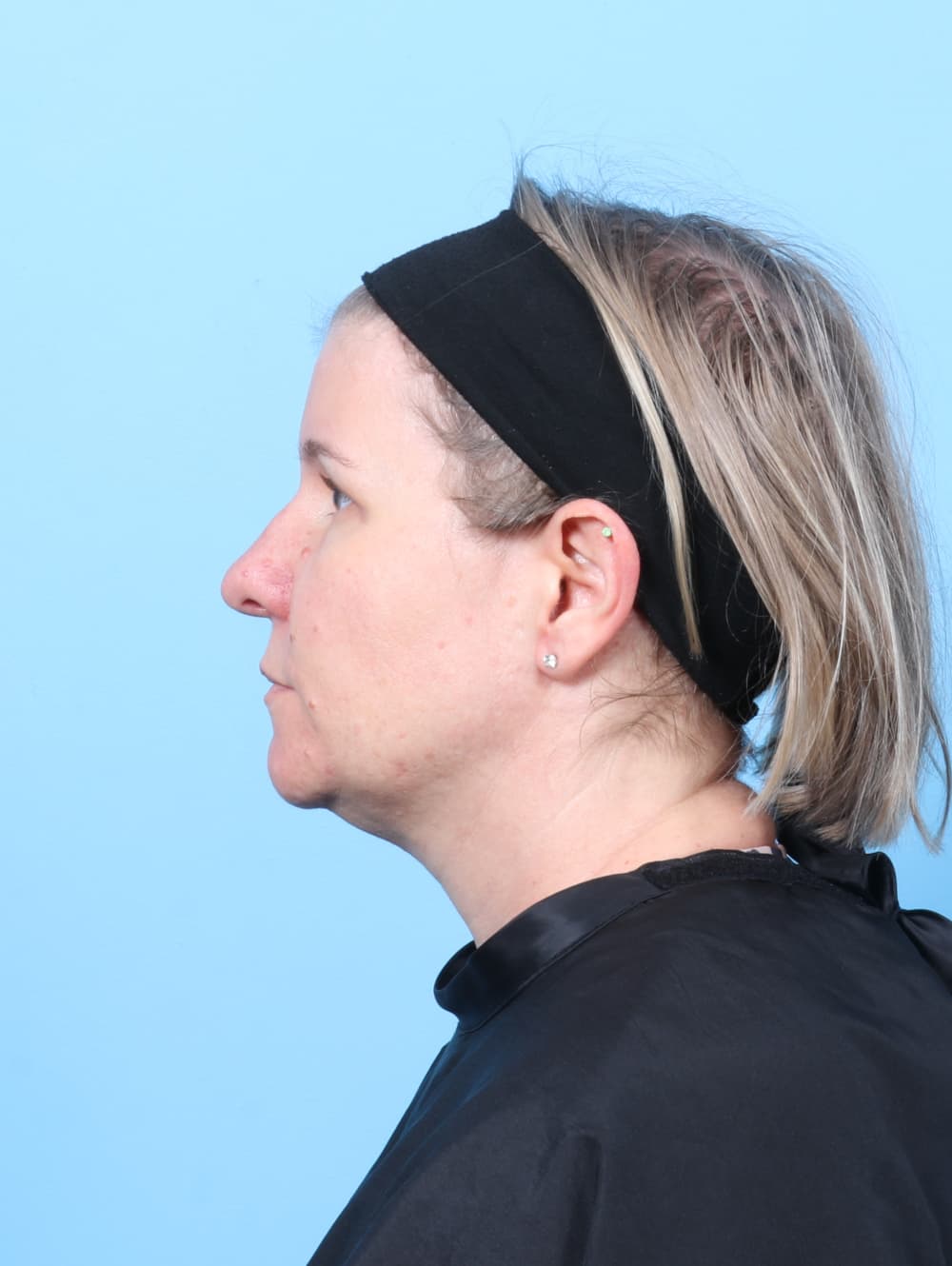 Brow Lift case #8610 after, image 3