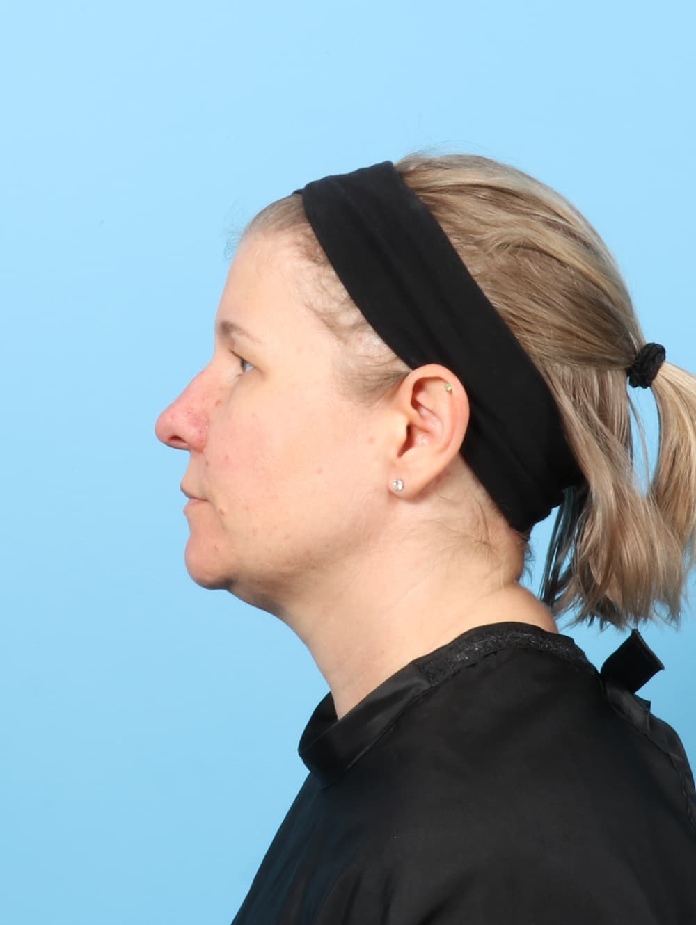 Brow Lift case #8610 before, image 3