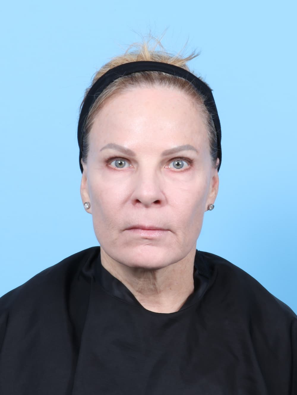 Eyelid Surgery case #7339 after