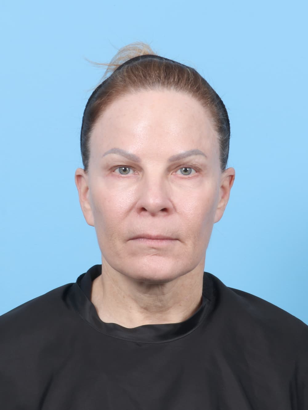 Eyelid Surgery case #7339 before