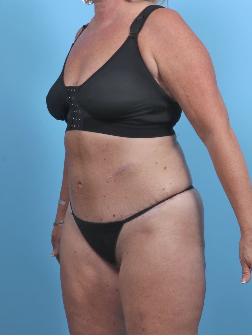Liposuction case #3914 after, image 3