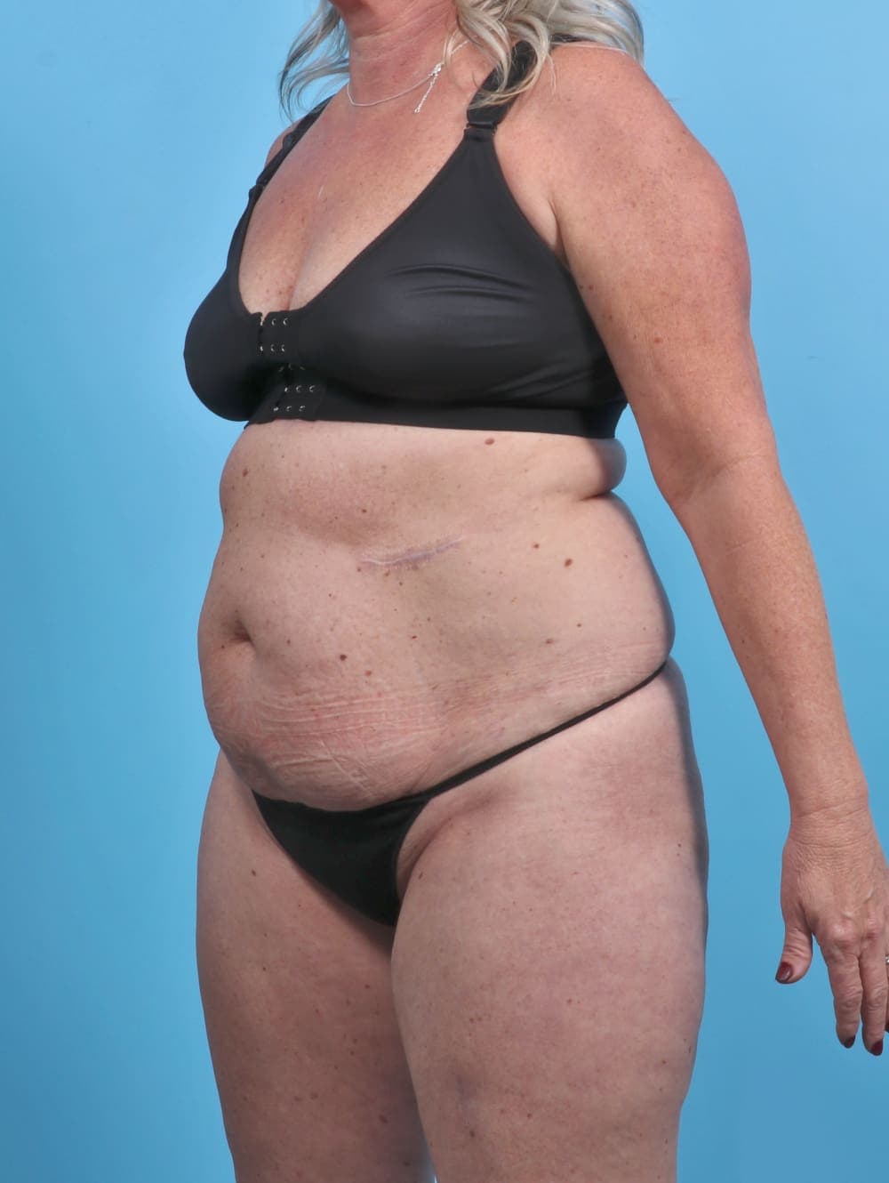 Liposuction case #3914 before, image 3