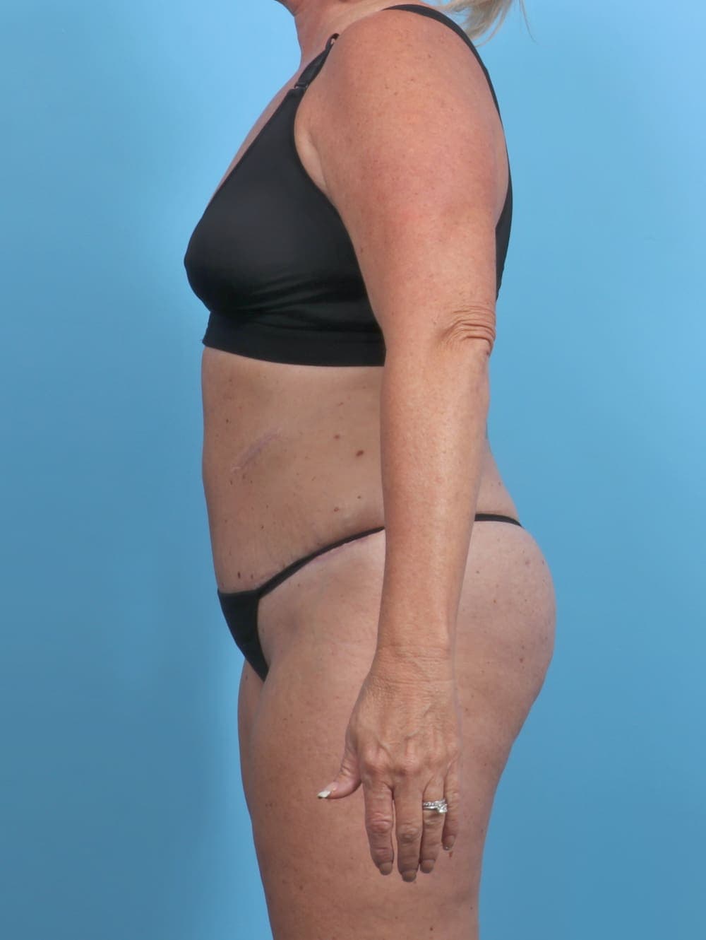 Liposuction case #3914 after, image 4