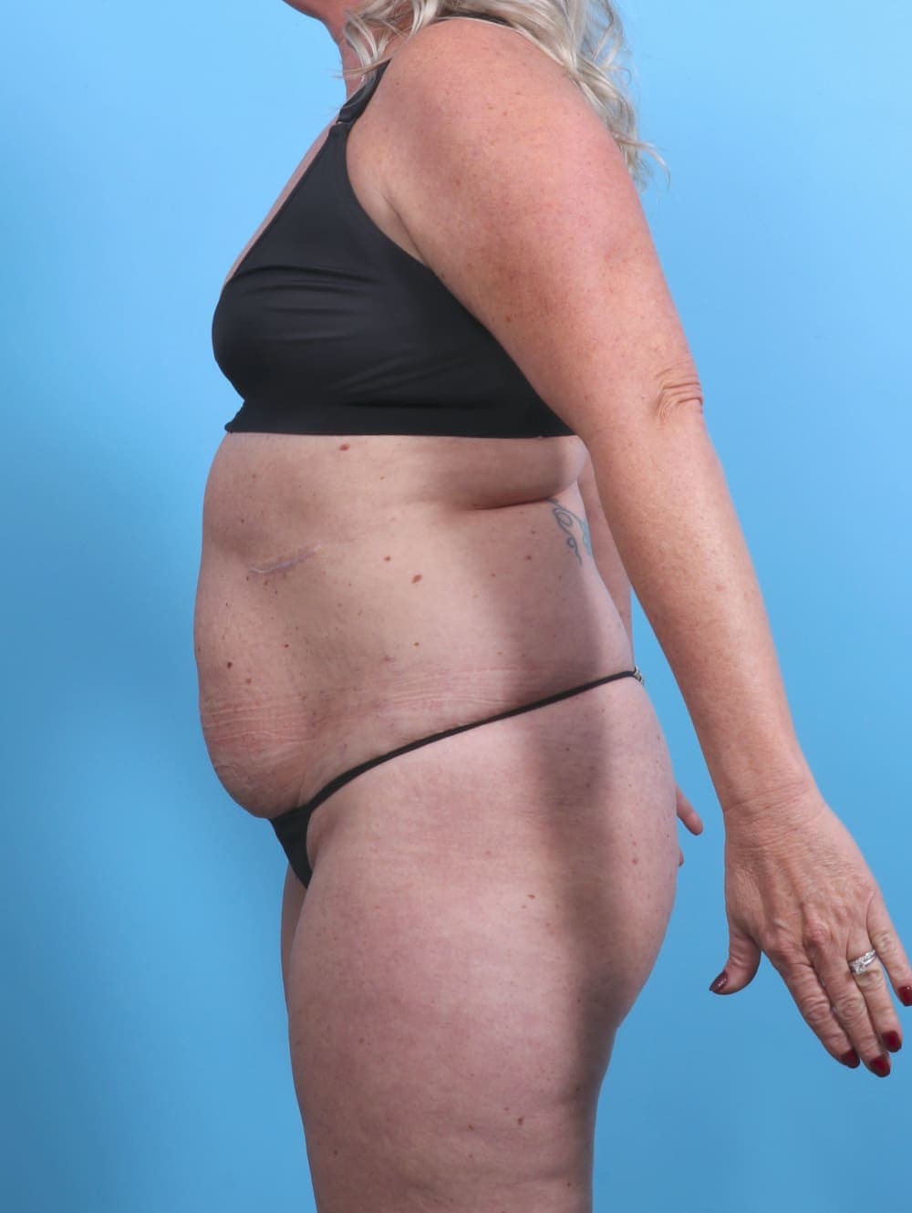 Liposuction case #3914 before, image 4