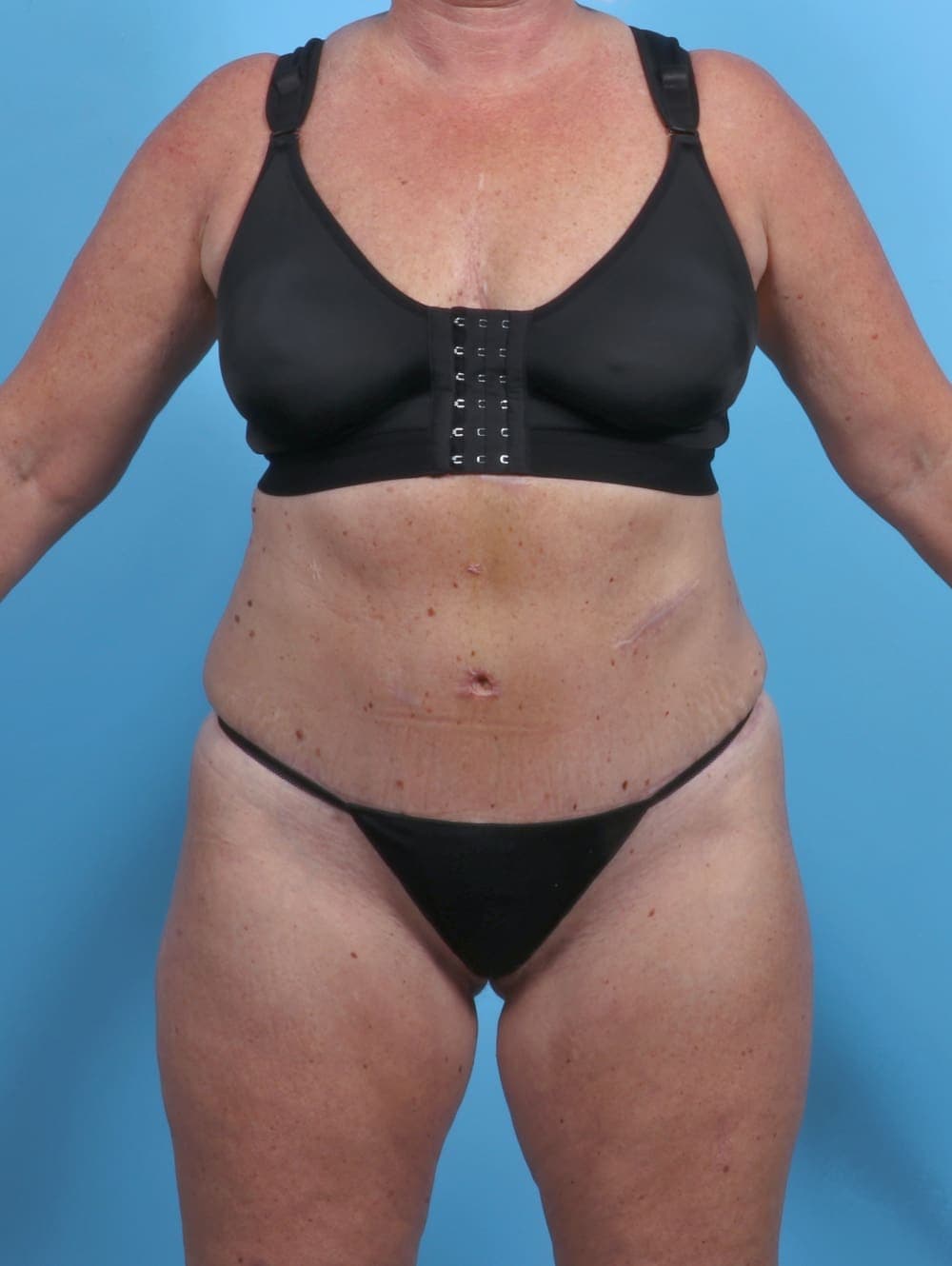 Liposuction case #3914 after, image 1