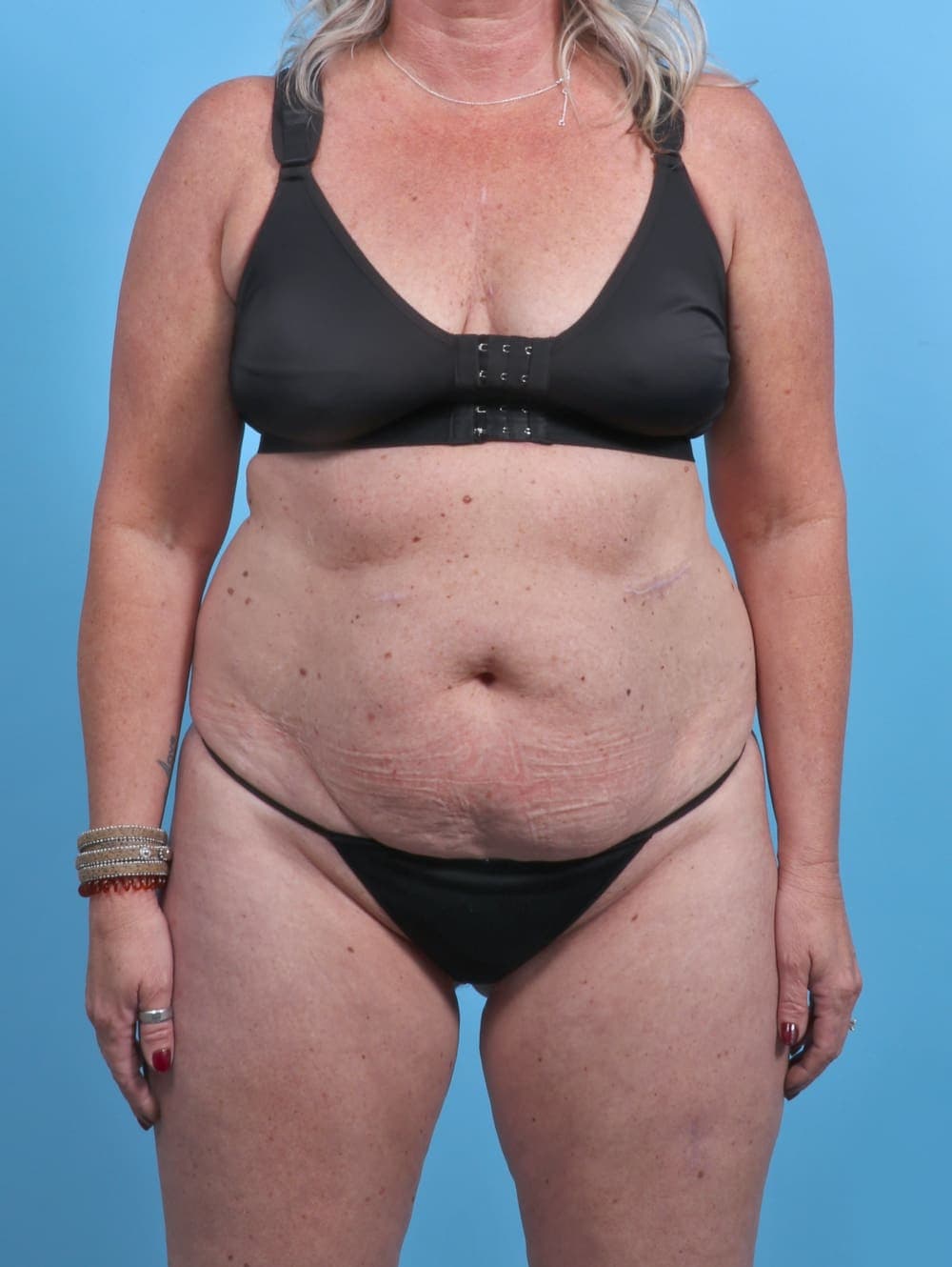 Liposuction case #3914 before, image 1