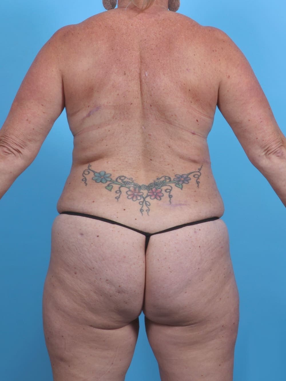 Liposuction case #3914 after, image 2