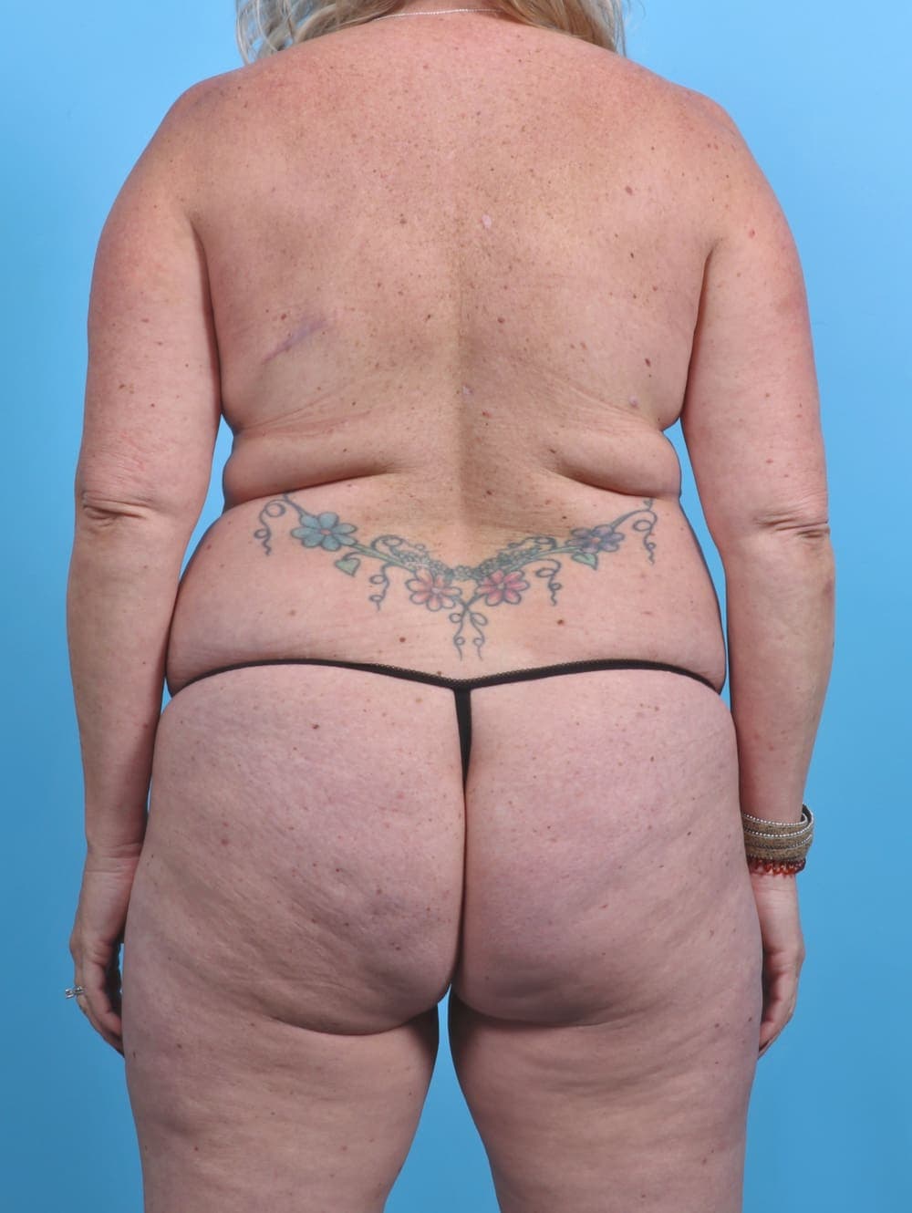 Liposuction case #3914 before, image 2