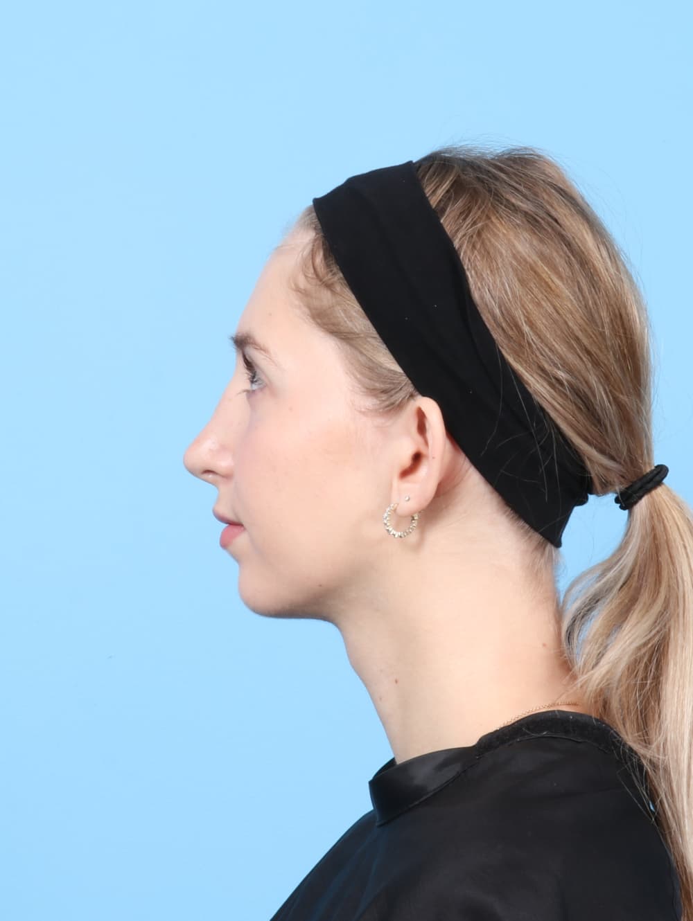 Rhinoplasty case #7477 after, image 1