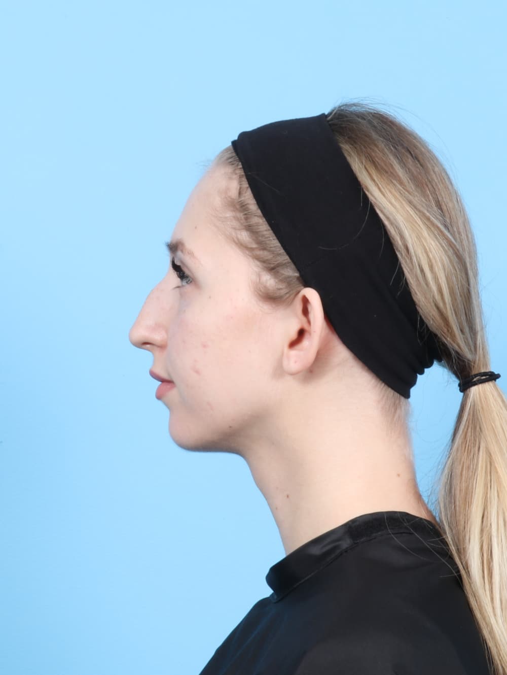 Rhinoplasty case #7477 before, image 1