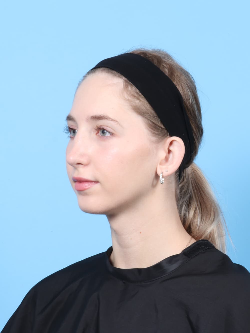 Rhinoplasty case #7477 after, image 3