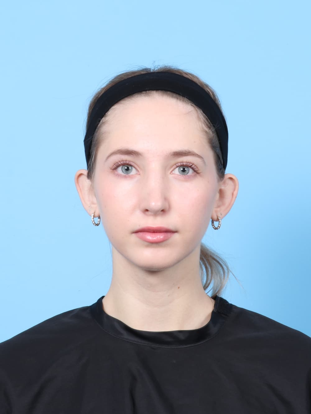 Rhinoplasty case #7477 after, image 2