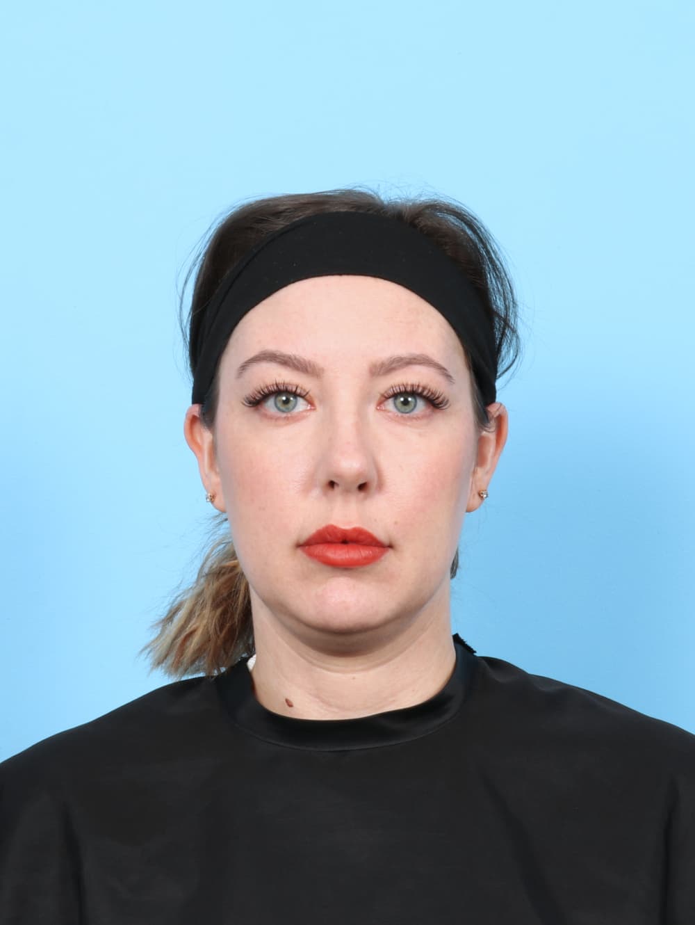Rhinoplasty case #7289 after, image 2