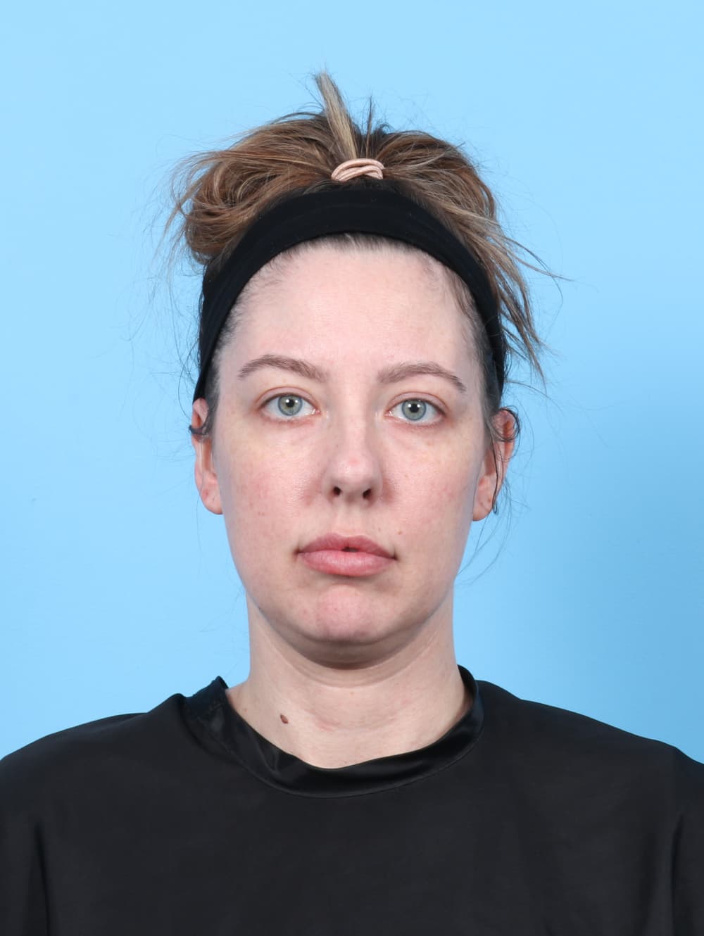 Rhinoplasty case #7289 before, image 2