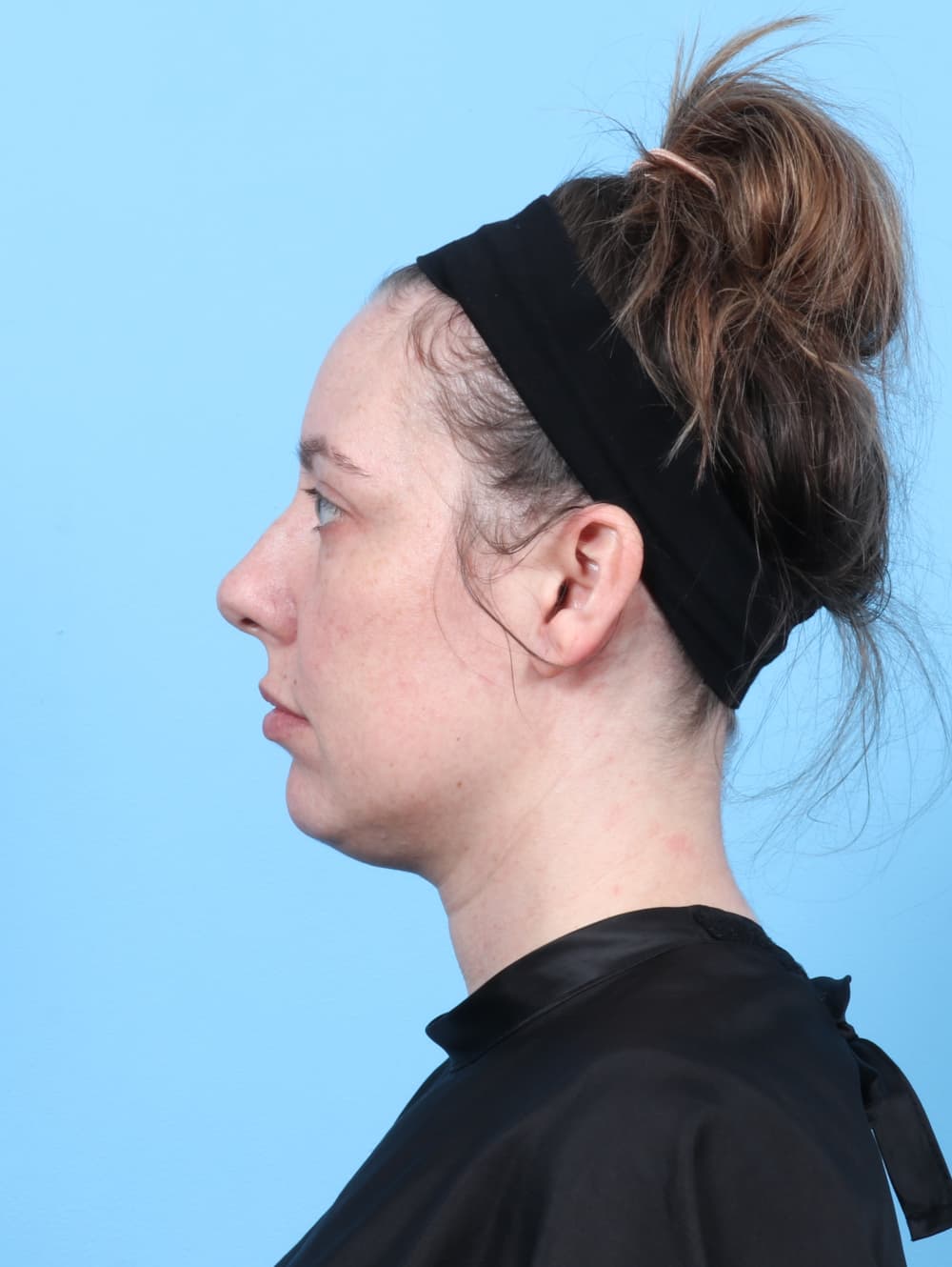 Rhinoplasty case #7289 before, image 1