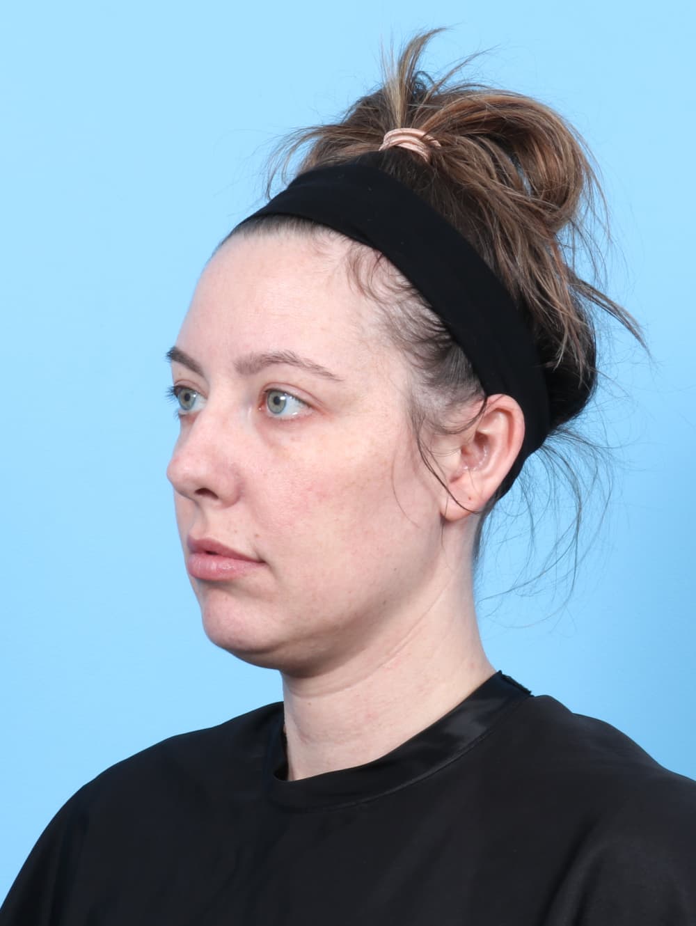 Rhinoplasty case #7289 before, image 3