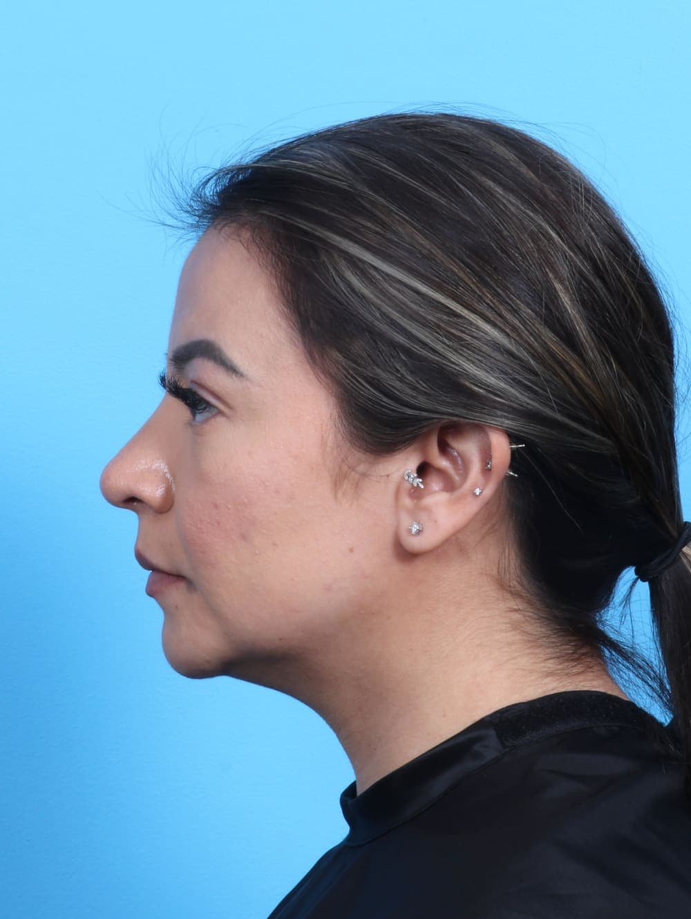 Rhinoplasty case #3279 after