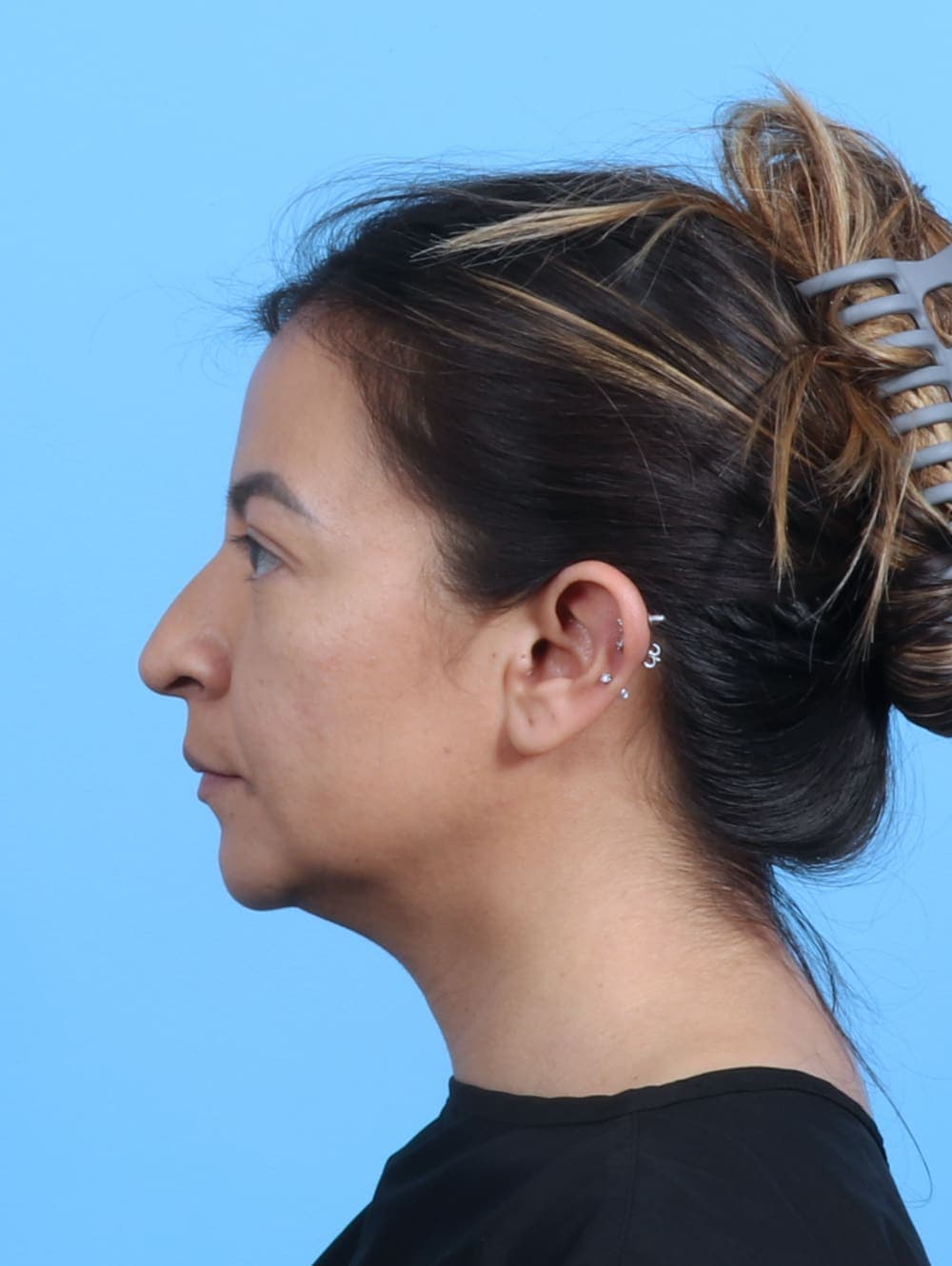 Rhinoplasty case #3279 before