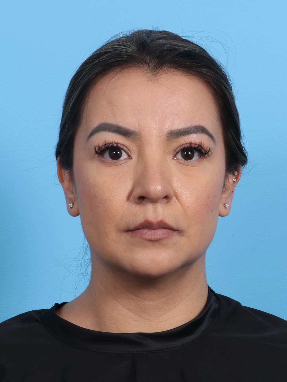 Rhinoplasty case #3279 after, image 2