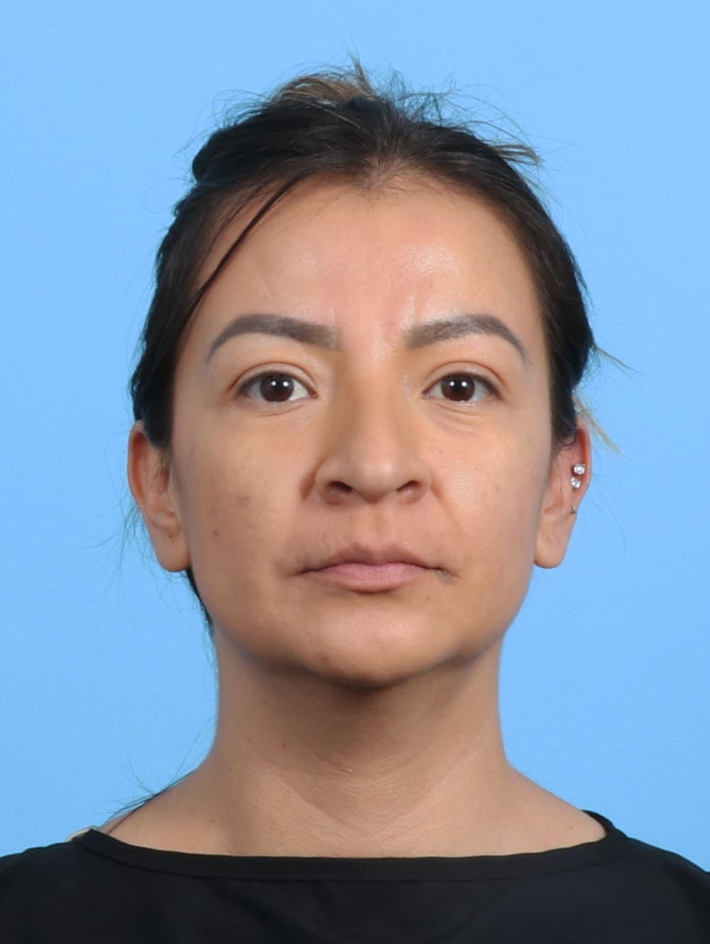 Rhinoplasty case #3279 before, image 2