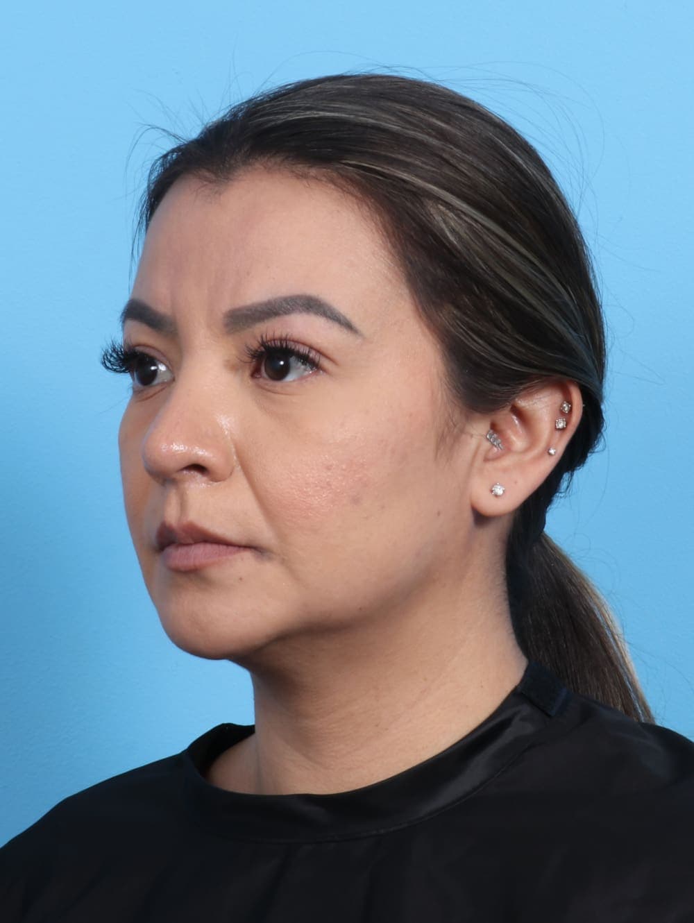 Rhinoplasty case #3279 after, image 3